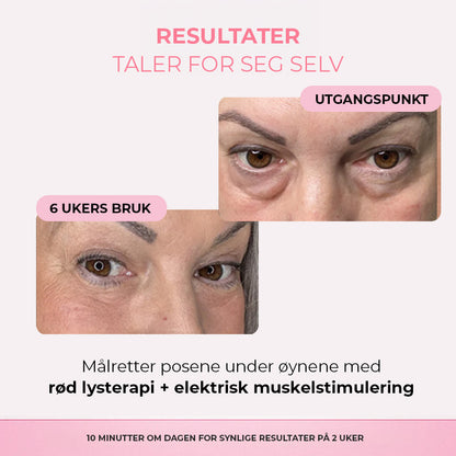 Revive Eyes® 2-i-1 rødt lysterapi + EMS for å fjerne poser under øynene
