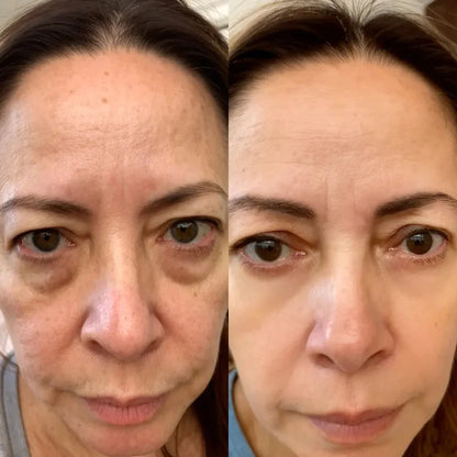 Revive Eyes® 2-i-1 rødt lysterapi + EMS for å fjerne poser under øynene