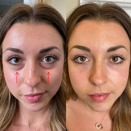 Revive Eyes® 2-i-1 rødt lysterapi + EMS for å fjerne poser under øynene